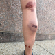 Liz Ferris’ right leg after a being hit by police stinger grenade at Black Lives Matter Plaza.